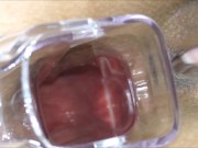 Anal fisting extreme and Speculum in ass 16/16