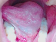 Tongue, Tonsils, and Throat Examination