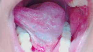 Tongue, Tonsils, and Throat Examination