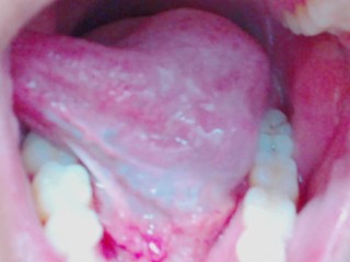 Tongue, Tonsils, and Throat Examination