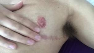 FtM Chest Scar Massage