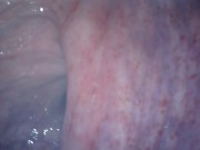 アナル内部　内視鏡　クスコ　直腸 1/16