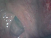 アナル内部　内視鏡　クスコ　直腸 11/16