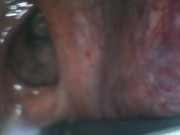 アナル内部　内視鏡　クスコ　直腸 13/16