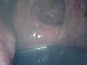 アナル内部　内視鏡　クスコ　直腸 4/16