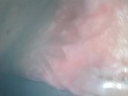 アナル内部　内視鏡　クスコ　直腸 6/16