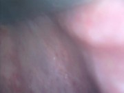 アナル内部　内視鏡　クスコ　直腸 8/16