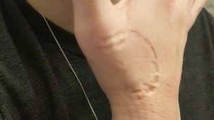 Self Biting with Perfect Teeth Impressions
