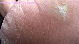 crack crack cracked heels and very close up