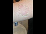 Girl hard biting Marks 12/16