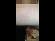 Girl hard biting Marks 6/16