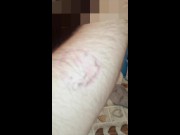 Girl hard biting Marks 7/16