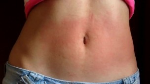 I show my red belly from the torture I received from the red belly game, my stomach inflamed