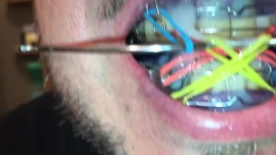 Cumming on my twinblock full of elastics and put it on my mouth