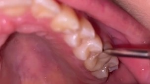Ultrasonic teeth cleaning. Teeth fetish.