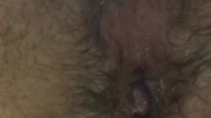 Hairy Ass Anal Hemorrhoid 