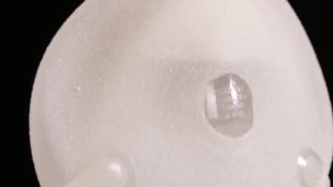 Gradual filling of expander breast implant with saline into twice its prescribed size