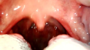 My throat with endoscope