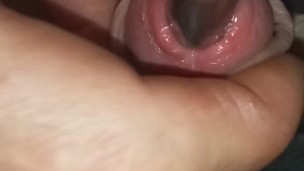 Urethral dilator 3