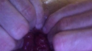 18 YEAR OLD EXTREME ANAL PROLAPSE, MASSIVE ASS HOLE FUCKED BY BBC