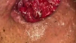 Anal Fisting And Prolapse TEASER