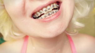 My 2nd day in braces: cleaning by dental floss