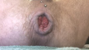 Prolapse Progress