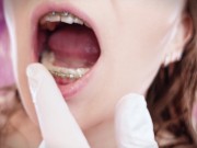 ASMR: upgraded braces with chain-link rubber bands and nitrile gloves (Arya Grander) 5/16