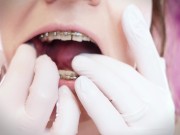 ASMR: upgraded braces with chain-link rubber bands and nitrile gloves (Arya Grander) 6/16