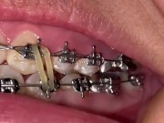 Mira que tanto metal tengo en mi boca 👄