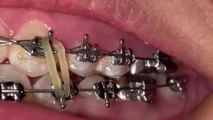 Mira que tanto metal tengo en mi boca 👄