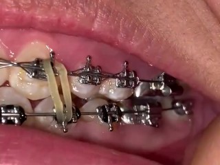 Mira que tanto metal tengo en mi boca 👄