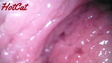 Endoscopic ♥vaginal observation