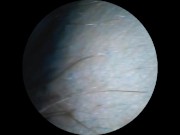 DP Endoscope for Andrew 10/16