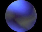 DP Endoscope for Andrew 11/16