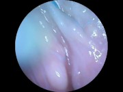 DP Endoscope for Andrew 12/16