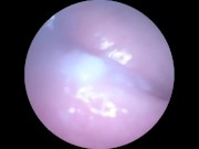 DP Endoscope for Andrew 14/16