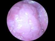 DP Endoscope for Andrew 9/16