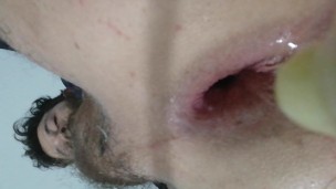 Anal Inflable Extremo Prolapso