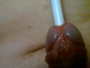 Urethral insertion with pen 2/16