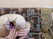 Anal dilation with 6 rode anal dilator 11/16