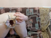 Anal dilation with 6 rode anal dilator 14/16