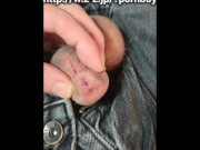 尿道下裂公開 15/16