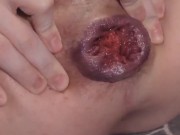 Inflatable Anal Dildo Stretching, Gaping & Prolapsing 5/16