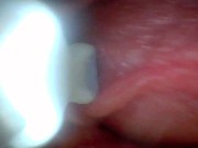 Endoscope camera shows the most sensitive parts of the penis Educational video 16/16