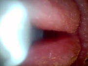 Endoscope camera shows the most sensitive parts of the penis Educational video 5/16